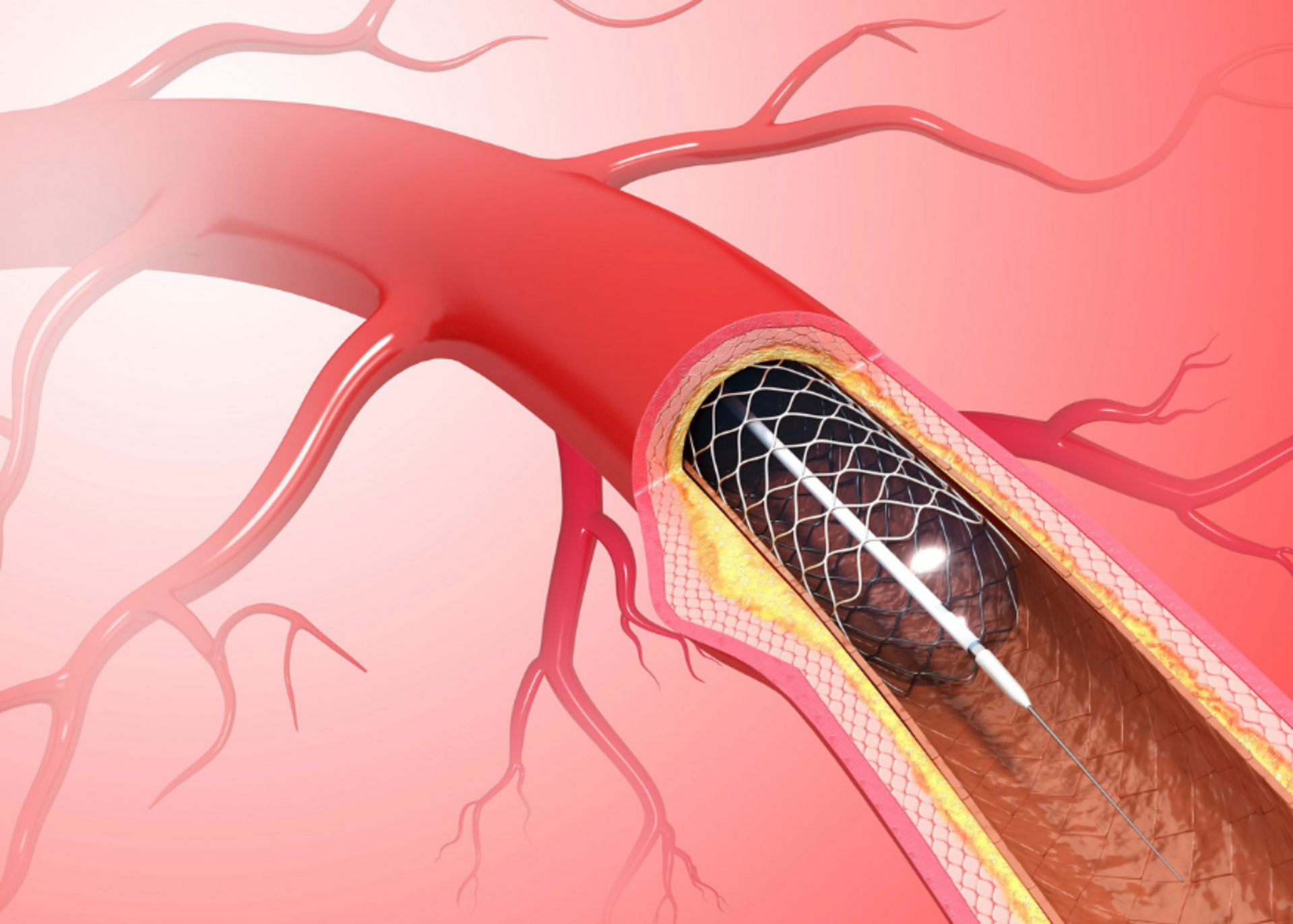 Coronary Angioplasty (PTCA)