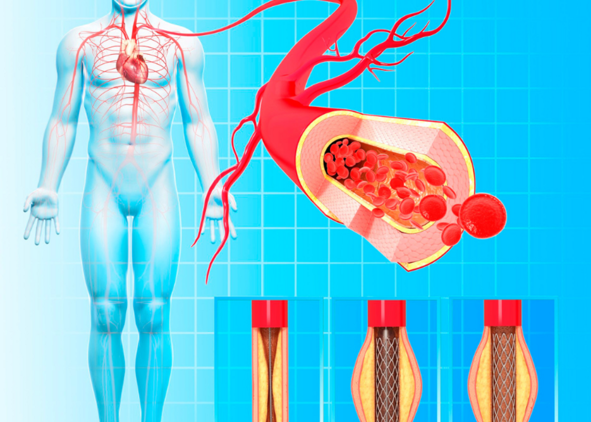 Peripheral Angioplasty