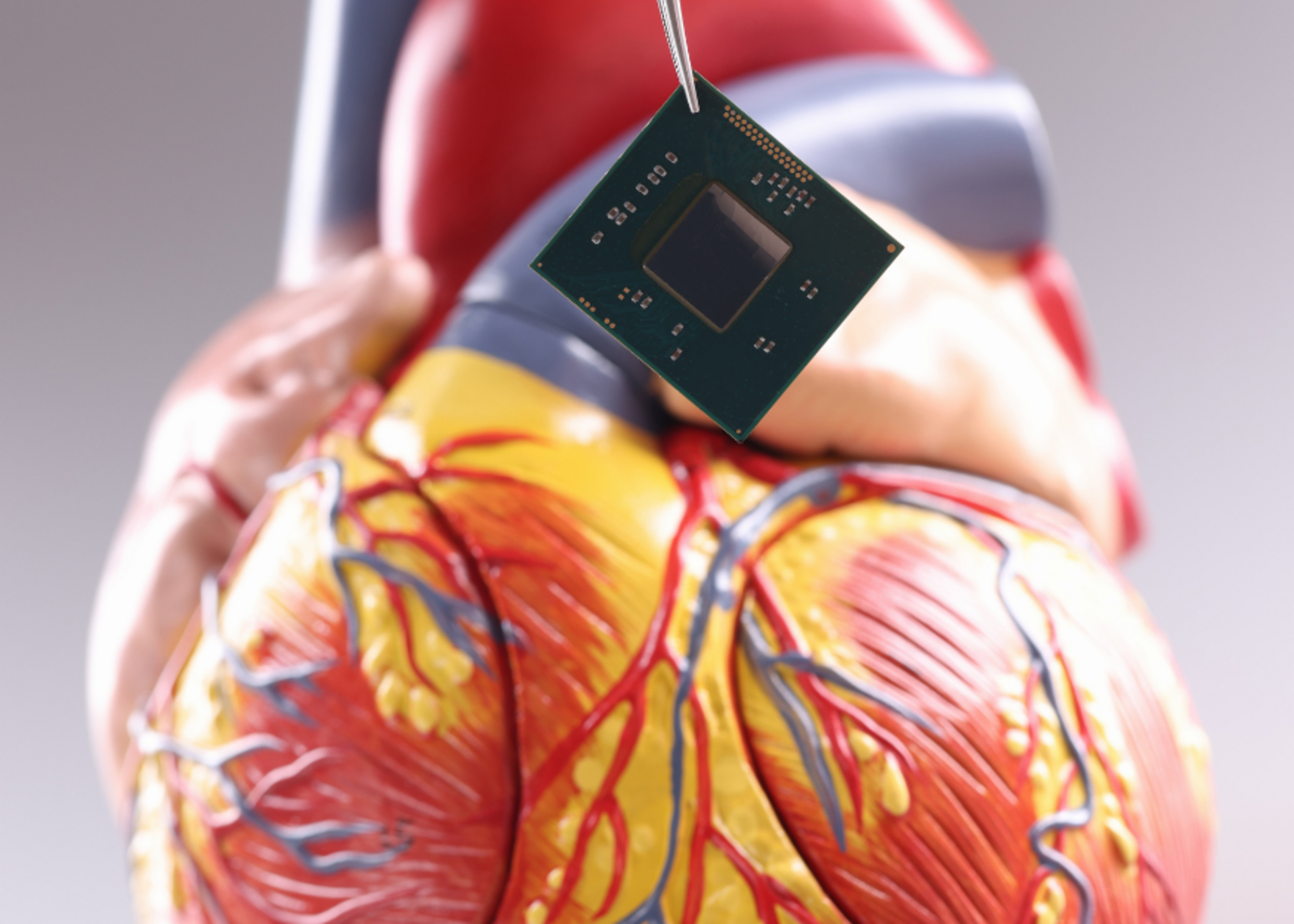 Implantable Cardioverter Defibrillator (ICD) Placement